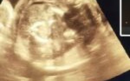 प्रेग्नेंट महिला के पेट में बच्चा और उस बच्चे के पेट में भी बच्चा… सोनोग्राफी देख दंग रह गए डॉक्टर....