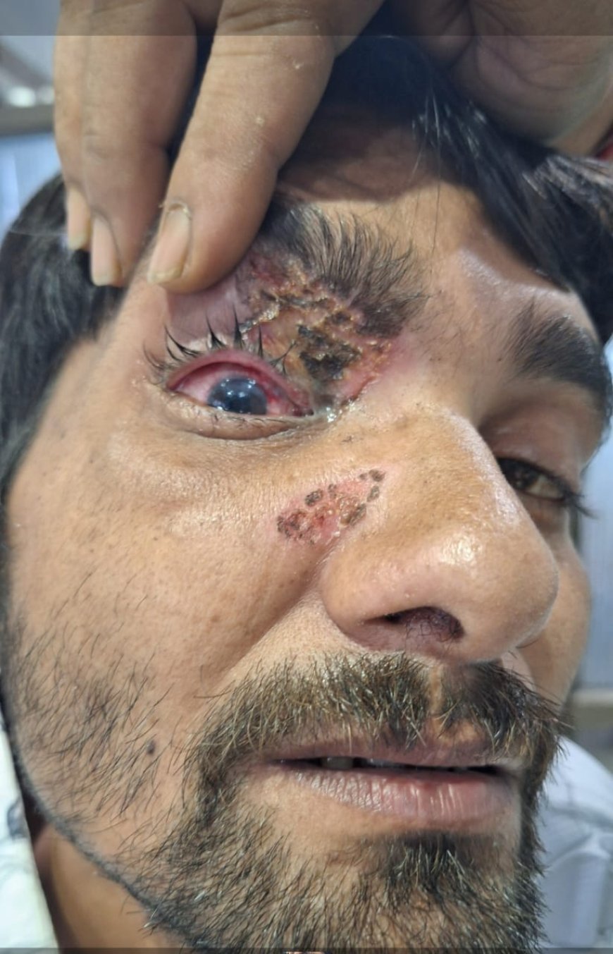 प्रदेश में भी कार्बाइड गन के प्रयोग पर बैन लगाया जाए. डॉ दिनेश मिश्र